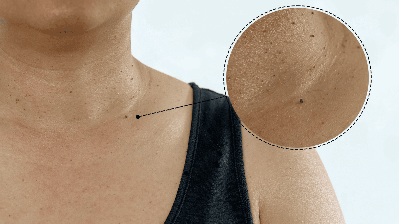 Włókniaki – nie tylko defekt estetyczny, ale sygnał przedcukrzycowy